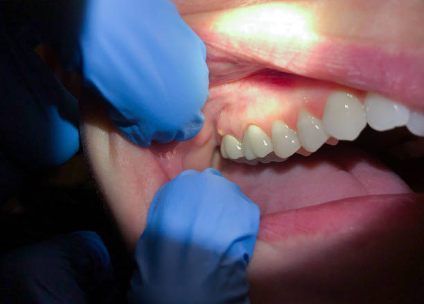 Best Broken or Cracked Tooth Emergency Dentist in Stevenson, WA